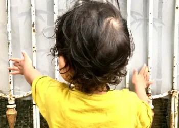 17 Anak Meninggal Akibat Campak di Sumenep Buktikan Pentingnya Imunisasi