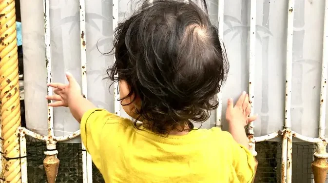 17 Anak Meninggal Akibat Campak di Sumenep Buktikan Pentingnya Imunisasi