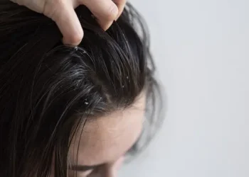 Cara Mengatasi Ketombe Membandel Berdasarkan Pendapat Ahli