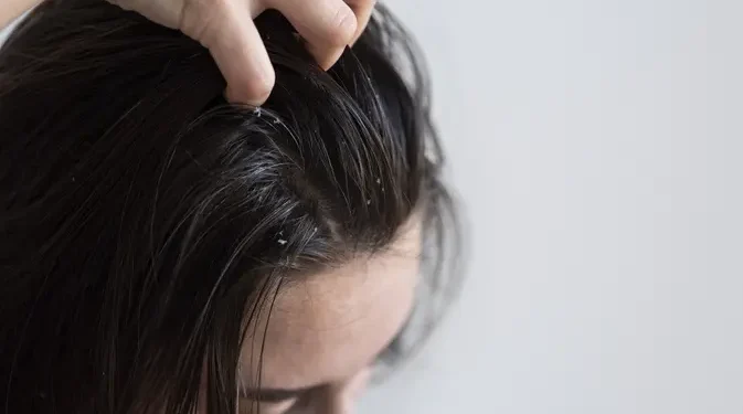 Cara Mengatasi Ketombe Membandel Berdasarkan Pendapat Ahli