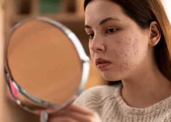 Purging Kulit: Efek Skincare Baru yang Sering Disangka Jerawat atau Breakout
