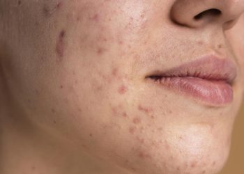 Alasan Jerawat Sering Muncul di Dahi, Pipi, dan Dagu serta Cara Mengatasinya