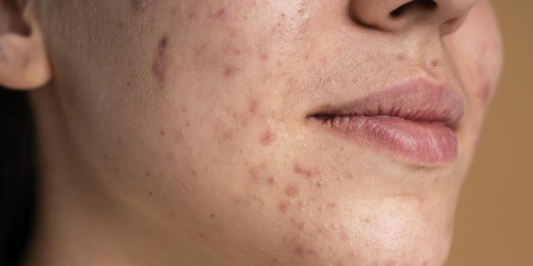 Alasan Jerawat Sering Muncul di Dahi, Pipi, dan Dagu serta Cara Mengatasinya
