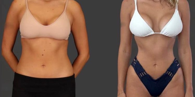 Fenomena Tubuh Ozempic, Wanita Buang Tulang Rusuk demi Pinggang Ramping