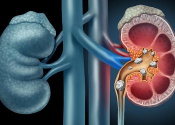 6 Penyebab Batu Ginjal yang Jarang Diketahui Selain Kurang Cairan