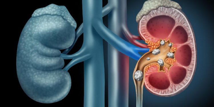 6 Penyebab Batu Ginjal yang Jarang Diketahui Selain Kurang Cairan