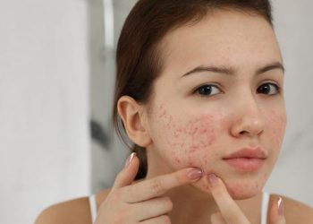 Penyebab Jerawat di Usia Matang dan Solusi Medis untuk Mengatasinya